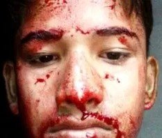 Picture of blood sweating